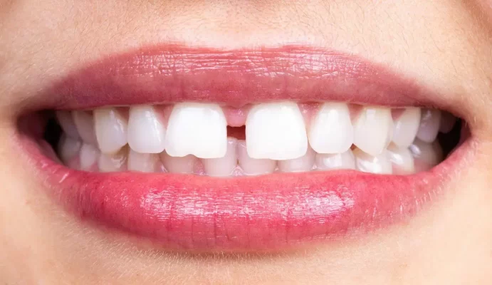 Gap in Teeth