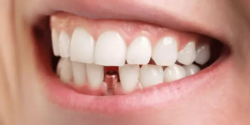 $ 399 tandheelkundige implantaten
