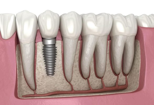 399 dolárov zubné implantáty