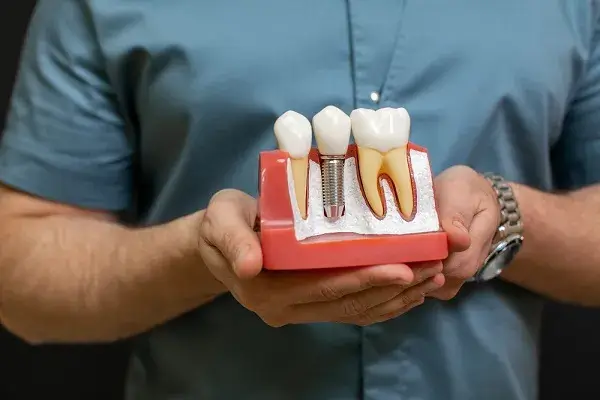 399 dollarë Implante Dentare