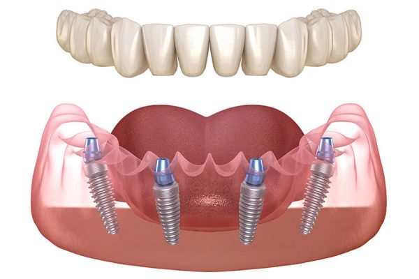 Fake Teeth Implants