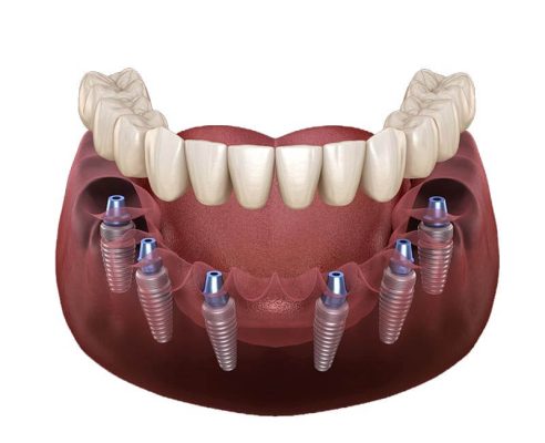 Full Mouth Implants Near Me