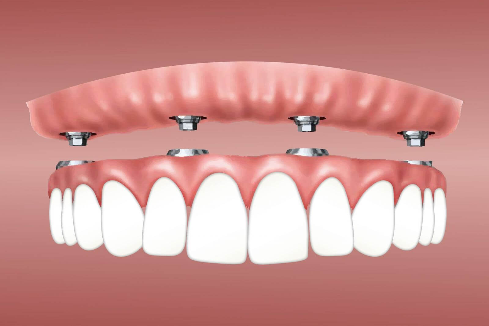 Dental İmplantlara Alternativ