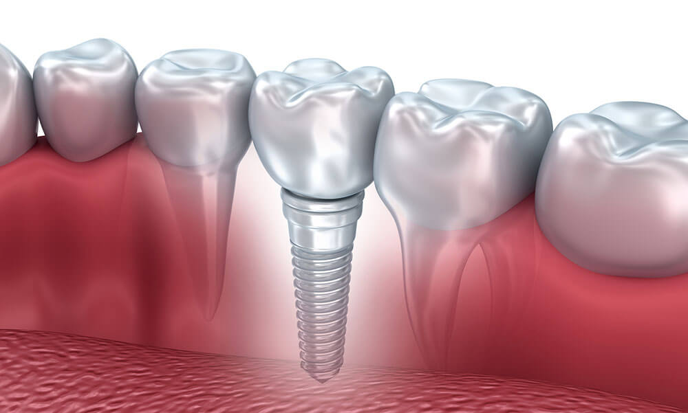 Levné zubní implantáty: stojí za to?