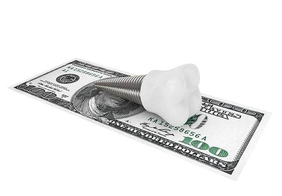 The Cheapest States for Dental Implants