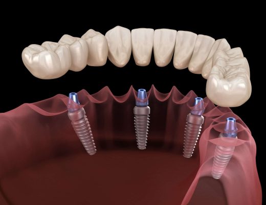 ClearChoice Dental Implants Cost