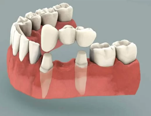 Dental implantlarga muqobil