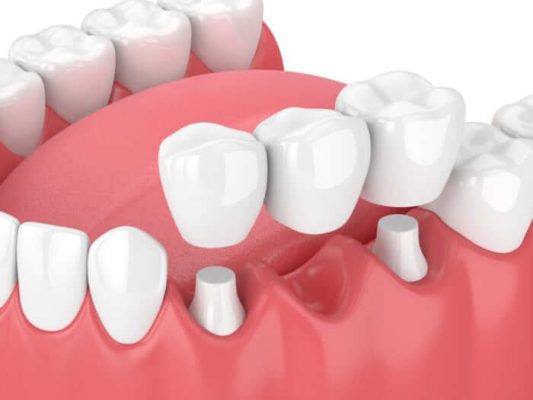 Alternatíva k zubným implantátom