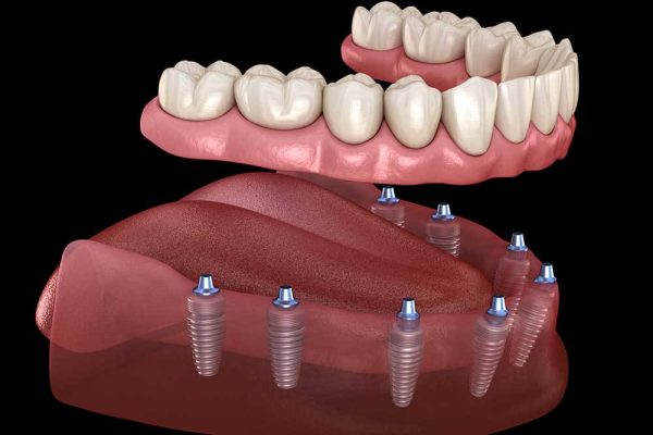 Dental Implants California