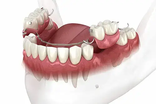 Alternatíva k zubným implantátom