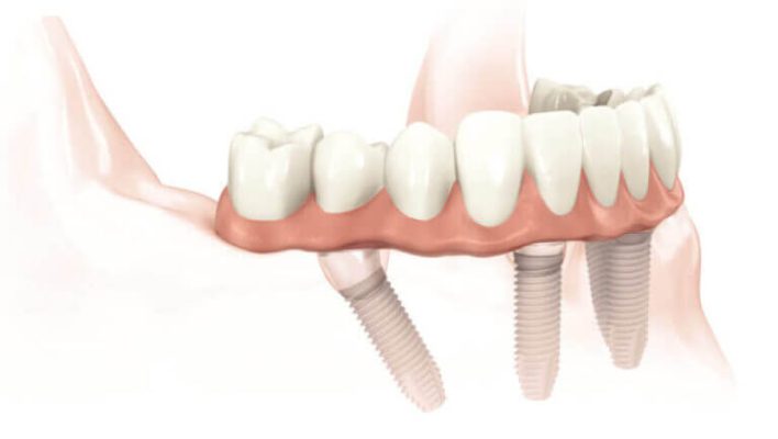 Youtube Video About Cost Of Dental Implants 