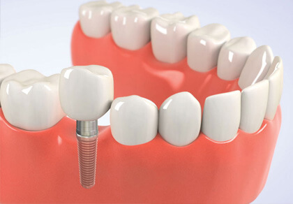 Недорогие зубные имплантаты