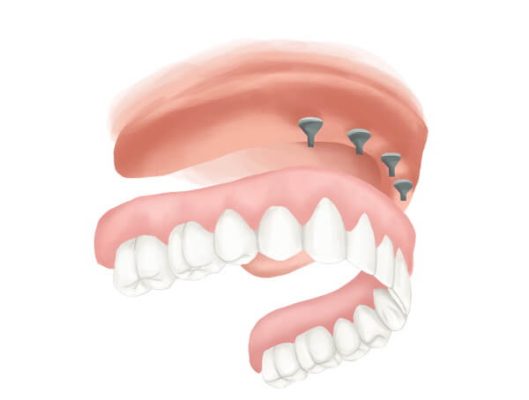El costo de los implantes dentales de boca completa con seguro