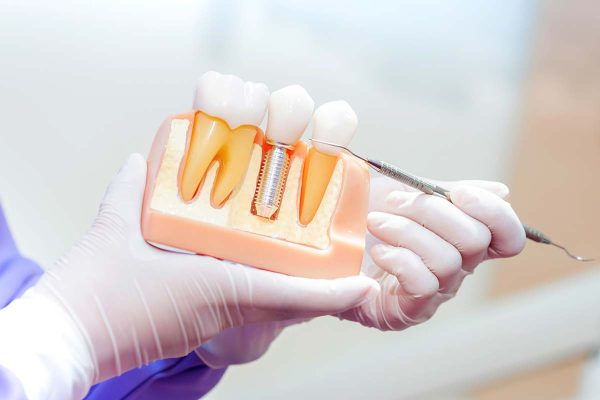 Видове зъбни импланти Цена