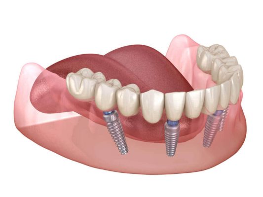 Najlacnejšie miesto Získajte zubné implantáty All-on-4