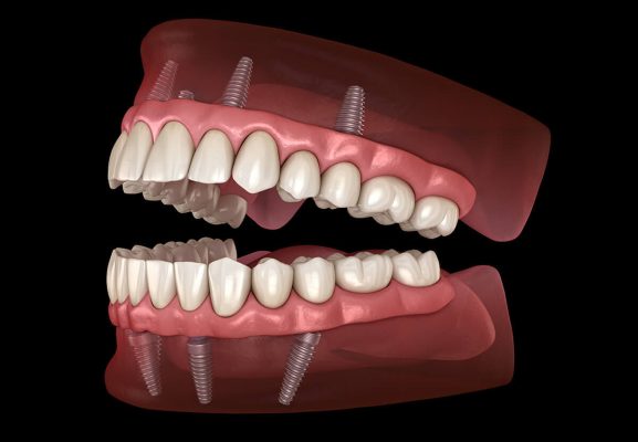 Eng arzon joy All-on-4 dental implantlarni oling