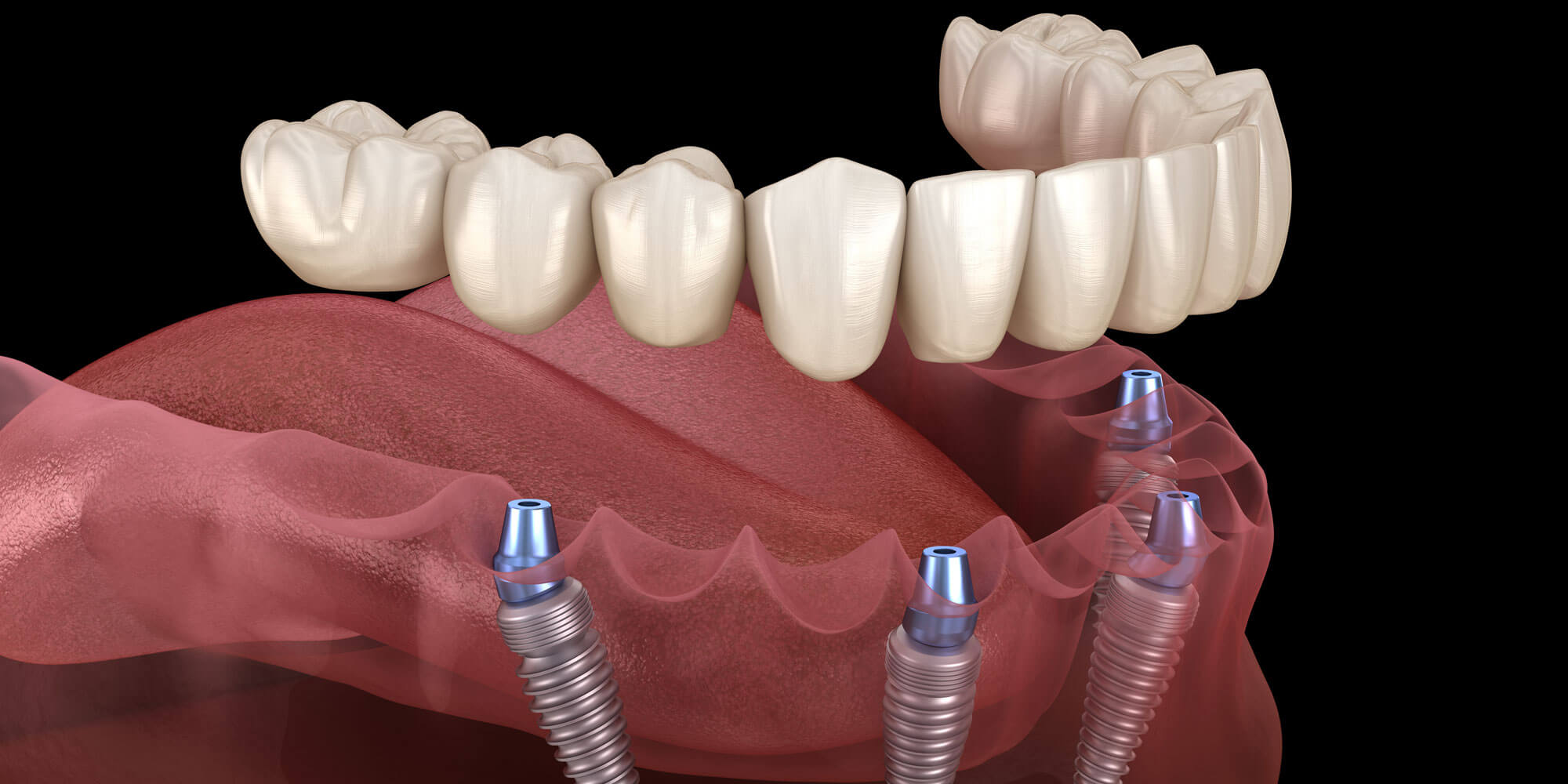 Full Mouth Implants Near Me