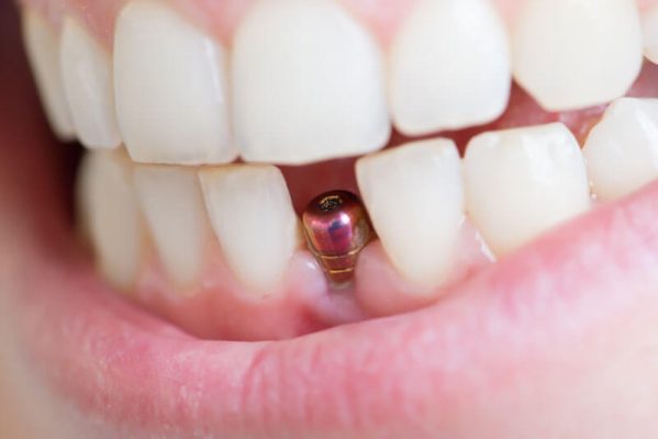NC Dental Implants