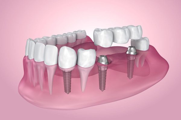 Nuvia Dental Implants