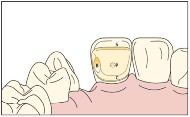 歯科インプラントの代替品