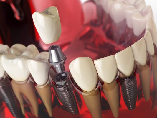 Implantes dentários baratos