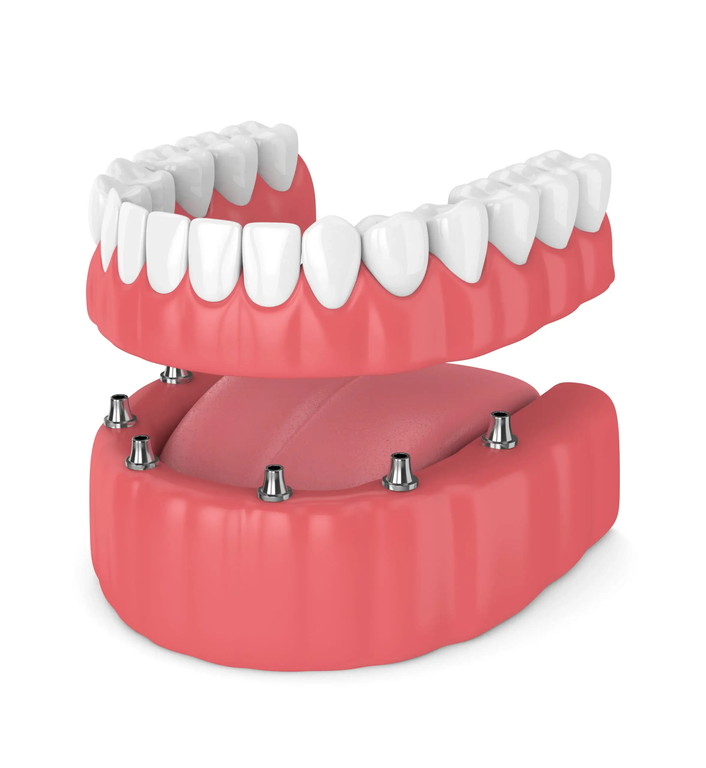 Kostoja e implanteve dentare me gojë të plotë me sigurim