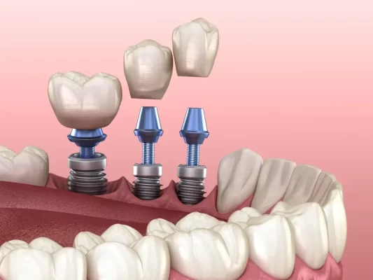 Dental Implants Florida