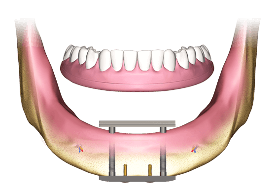 Typy nákladov na zubné implantáty