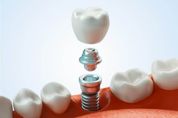 $1200 Dental Implants