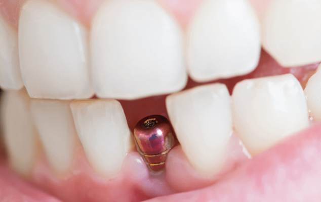 Dental Implants Look