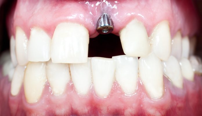 Dental Implants Look