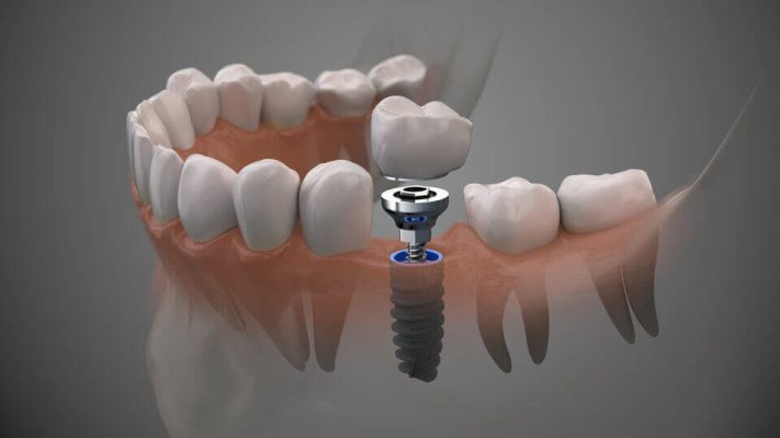 Affordable Dental Implants 2023