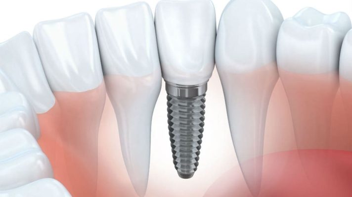 Zubné implantáty Suwanee GA
