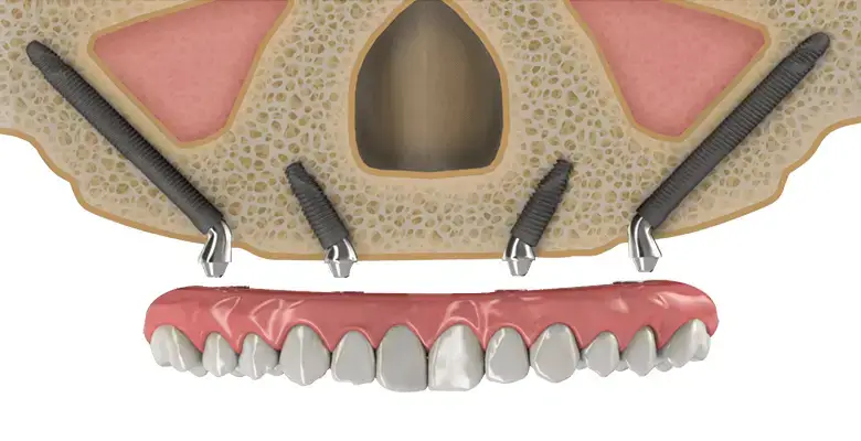 Llojet e kostos së implanteve dentare