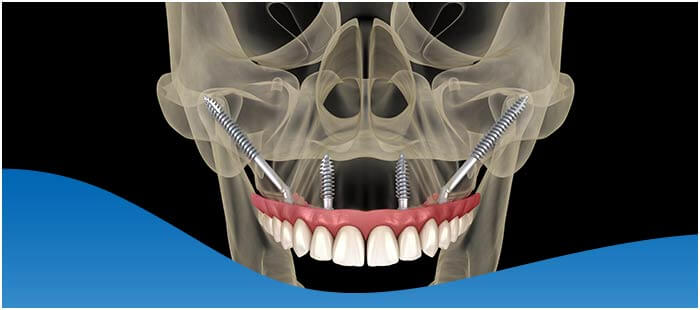 dental implants look