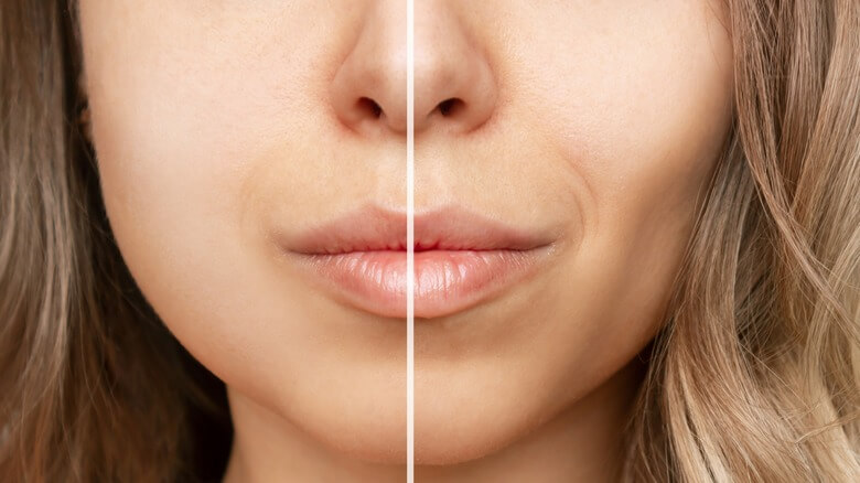 The Buzz around Buccal Fat Removal: What You Need to Know
