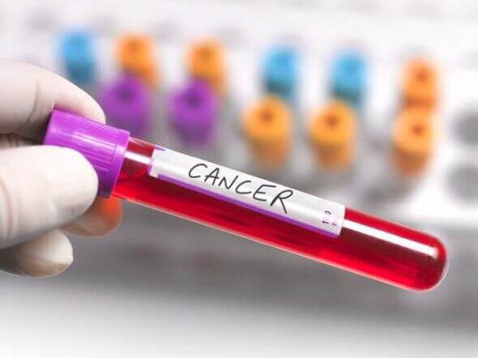 Ovarian Cancer Test