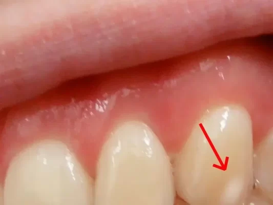 Hvide pletter på tænderne