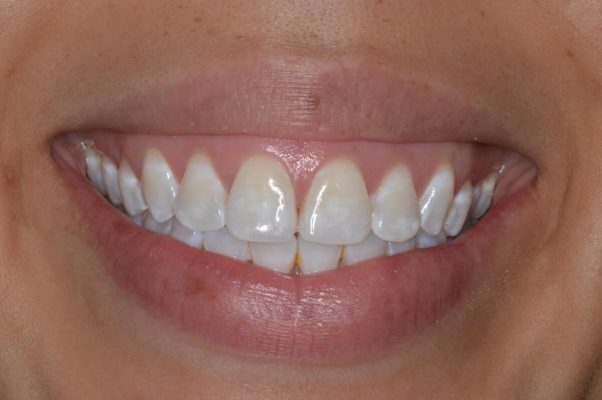 歯の白い斑点