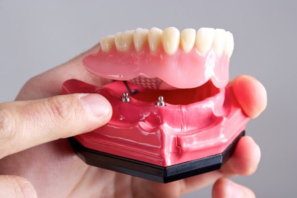Σταθερές οδοντοστοιχίες