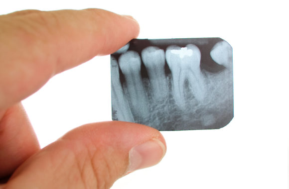 399 dolárov zubné implantáty